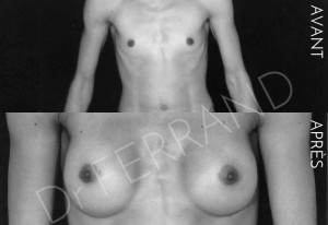 Agénésie mammaire, correction par prothèse